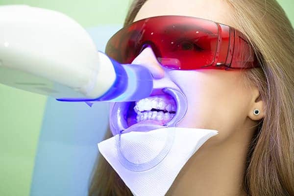 Laser teeth whitening treatments Milton Keynes