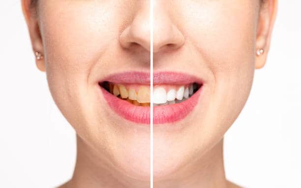 Teeth Whitening Milton Keynes Milton Keynes