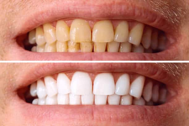 Laser White For Ever Bright – Get a Brighter, Whiter Smile with LA Teeth Whitening Milton Keynes