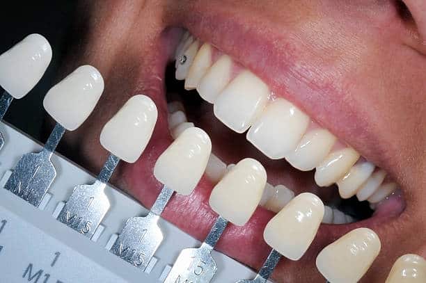 Get Natural and Stunning Smile with Teeth Whitening Results from LA Teeth Whitening Milton Keynes