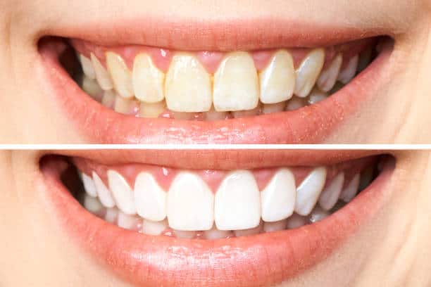 Achieve a Dazzling Smile for Your Special Day: A Guide to Wedding Teeth Whitening Milton Keynes