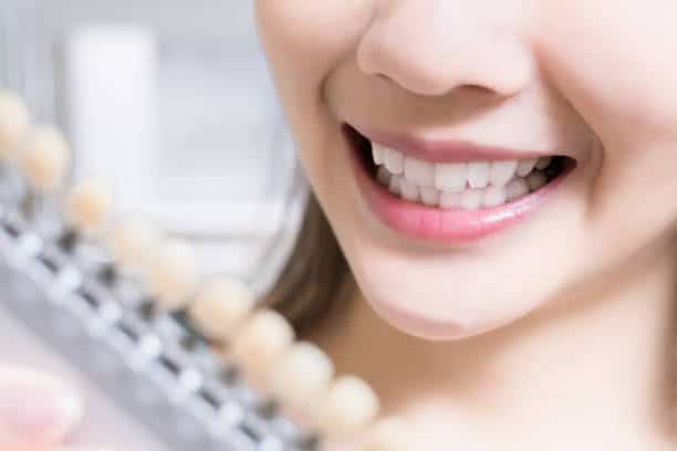 Teeth Whitening Kings Norton Milton Keynes