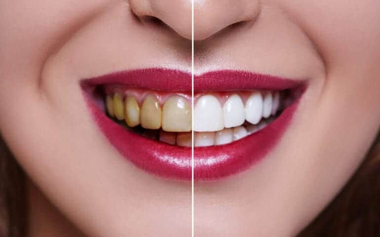 Teeth Whitening Ascot Windsor Milton Keynes