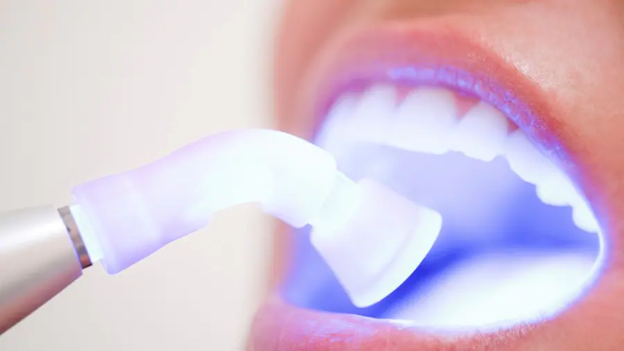 Teeth Whitening Aylesbury Milton Keynes