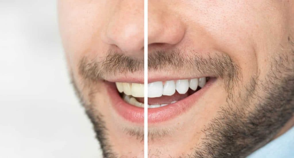 Teeth Whitening Bedfordshire Milton Keynes