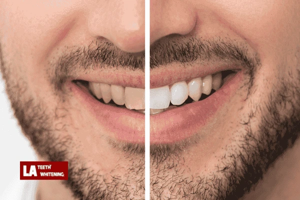 How Many Laser Whitening Treatments Are Needed? Milton Keynes